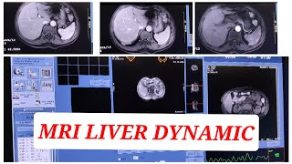 MRI Liver Triphasic  Dynamic Liver [upl. by Aramo]