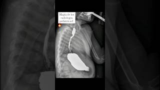 Subclavia derecha aberrante por fluoroscopia ✅ pediatrics pediatria radiology [upl. by Murphy]