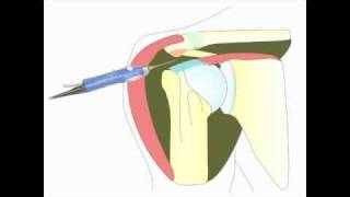 Acromioplastie arthroscopique de lépaule pour tendinite [upl. by Dolhenty]