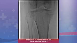 Angioplastia Periferica Compleja [upl. by Enomis]