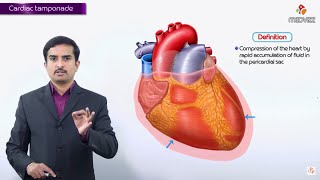 Cardiac Tamponade  causes ECG Diagnosis Pathology Clinical findings Treatment [upl. by Yedok]