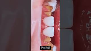 fundas de EMAX disilicato de litio dientes [upl. by Addi]