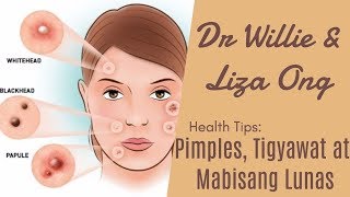 Pimples Tigyawat at Mabisang Lunas – by Doc Katty Go Dermatologist 33 [upl. by Aloeda]