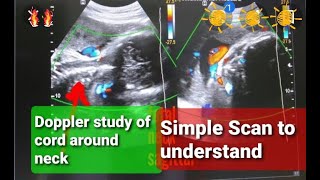 Cord around neck l Colour doppler study l SD Ratio l [upl. by Ratha]