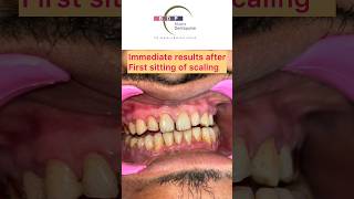 Watch if you have Teeth Stains teethcleaning teeth teethwhitening [upl. by Haldeman703]