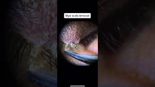 Stye Scab Removal [upl. by Enilrem]