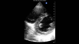 Flat interventricular septum Dshaped LV D sign in pulmonary hypertension [upl. by Sukul]