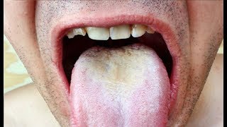 how to get rid of a white tongue immediately [upl. by Eivod]