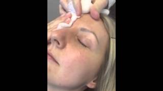 Laser removes under eye blue veins by Berman Skin Institute [upl. by Jeraldine]