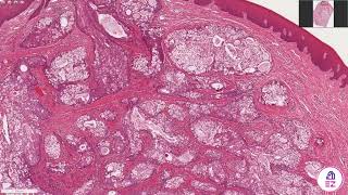 Mucoepidermoid Carcinoma [upl. by Erdnad196]