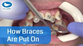 How braces are put on  AMAZING   Now with 12 month  Progress  httpsgoogljXaY15 [upl. by Nauwtna]