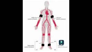 se la pressione arteriosa alle caviglie è bassa [upl. by Gnof]