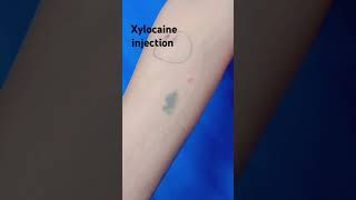 xylocaine injection viralshort video [upl. by Thibault20]