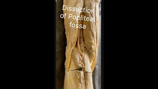 Popliteal fossa Dissection of popliteal fossa Anatomy of popliteal fossa Contents popliteal fossa [upl. by Werra]