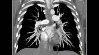 Lung Anatomy Pulmonary Embolism VRT [upl. by Boar]