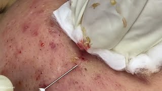 Big Cystic Acne Blackheads Extraction Blackheads amp Milia Whiteheads Removal Pimple Popping [upl. by Jefferey]