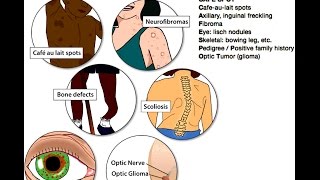 Neurofibromatosis Type 1 NF1 Mnemonic for Licensing Exams [upl. by Putscher]