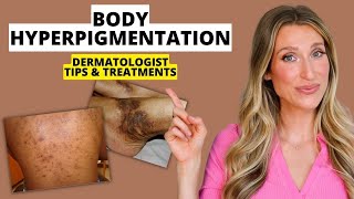 Dermatologist Explains Body Hyperpigmentation What Causes It Best Treatments Prevention amp More [upl. by Notwen]