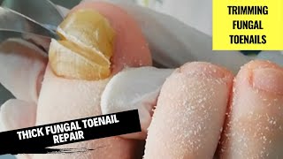 Thick Fungal Toenail Repair 🦶 Ingrown Fungal Nail Treatment 🦶 Podiatry Foot Exam [upl. by Annal310]