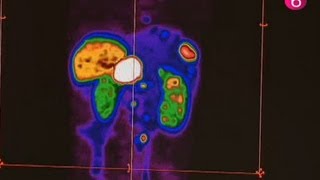 Traitement tumeur neuroendocrinale à Bordet [upl. by Niltak267]