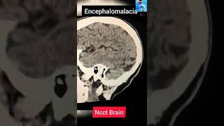 Ct scan Brain findings [upl. by Nelie955]