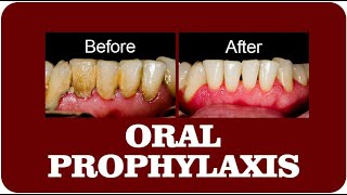 Oral Prophylaxis and Scaling Essential Dental Procedures for Healthy Teeth [upl. by Gow]