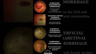 retinal hemorrhage types [upl. by Aitselec478]