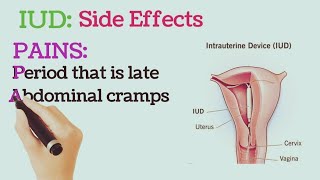 Intrauterine Device IUD Side Effects [upl. by Proudfoot261]