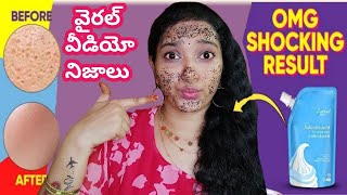 Salicylic Acid Mask in TeluguSalicylic Acid Ice Cream Mask Review in TeluguSalicylic acid icecream [upl. by Amoakuh]