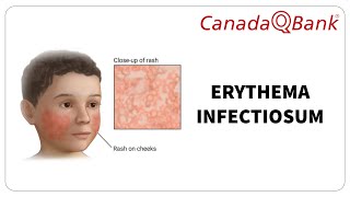 Erythema Infectiosum [upl. by Orthman]