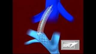 Endoprosthesis  Transjugular Intrahepatic Portosystemic Shunt TIPS [upl. by Nelon]