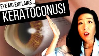 KERATOCONUS and What To Do About It  All About Cornea Crosslinking [upl. by Llerrod890]