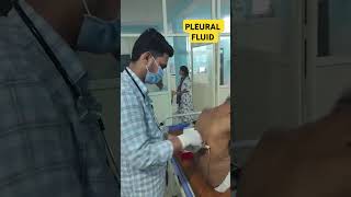 PLEURAL FLUID  Drain tb cancer drsatyampathak doctor medicotips pleuralfluid lungs cough [upl. by Ateekal722]