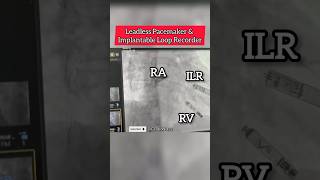 Leadless Pacemaker amp Implantable Loop Recorder on fluoroscopy heart Cardiology [upl. by Maffa]