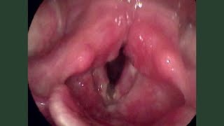 Laryngeal Tuberculosis TB [upl. by Eceinaj]