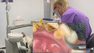 Dental care  removal calculus  teeth scaling [upl. by Metcalf413]