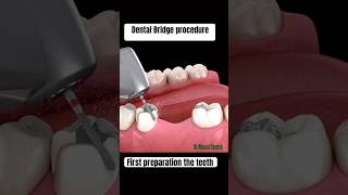 Dental Bridge Procedure [upl. by Ainos]