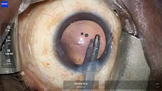 Intraoperative Zonular dialysis managed with Capsular Tension Ring CTR Dr Sheetal Brar [upl. by Yezdnil]