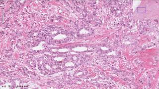 Ductal Carcinoma  Breast [upl. by Onfre]