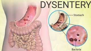 What is Dysentery Bacillary dysentery Amoebic dysentery DysenterysymptomsDiagnosis Treatment [upl. by Collis382]