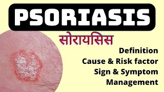 psoriasis skin disease in hindi  Cause risk factor symptoms and treatment  MSN  soriasis [upl. by Dlareme]