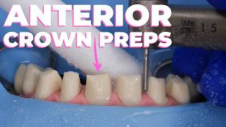 How To Anterior Crown Preps with Dr Lincoln Harris [upl. by Notlef965]