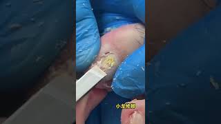 Ingrown Toenail Removal Procedure [upl. by Elwyn]