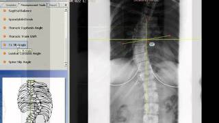 TraumaCad  T1 Tilt Angle [upl. by Kravits285]