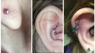 How do I get rid of a Keloid  hypertrophic scar aka piercing bump [upl. by Ardnad]