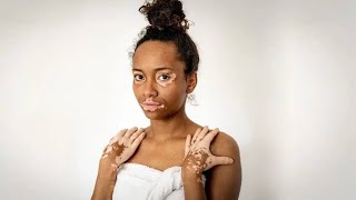 The herbal medicine that works for Vitiligo DoctorIyhere [upl. by Addam]