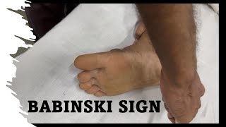 Babinski Sign The Extensor Plantar [upl. by Sauer]