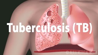 Tuberculosis TB Progression of the Disease Latent and Active Infections [upl. by Mokas]