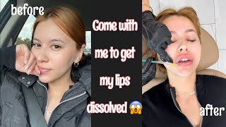 I GET MY LIP FILLERS DISSOLVED😱😱 [upl. by Sholom]