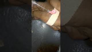 IV Cannulation Technique Porcedure [upl. by Nnil729]